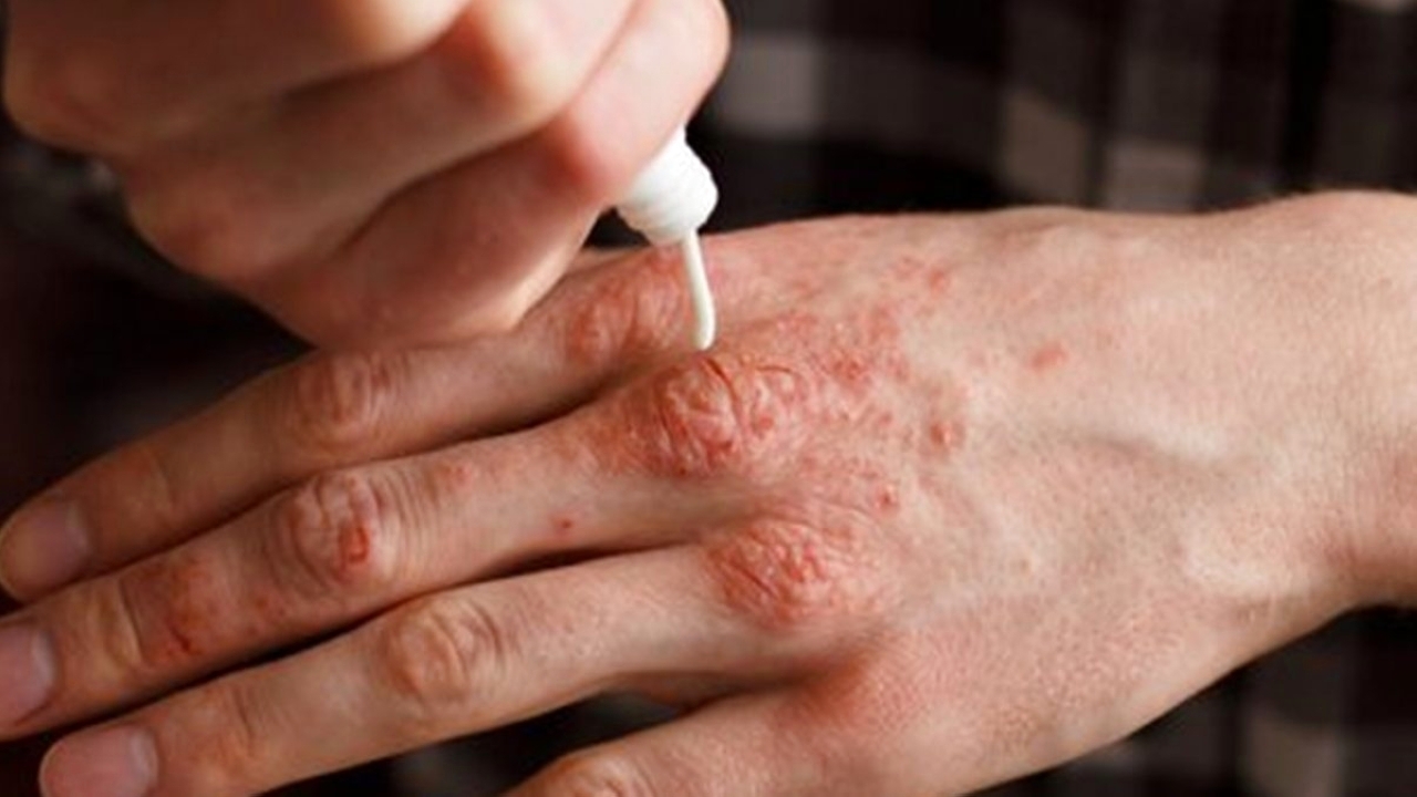 صحة.. لقاء تحسيسي عن مرض الصدفية