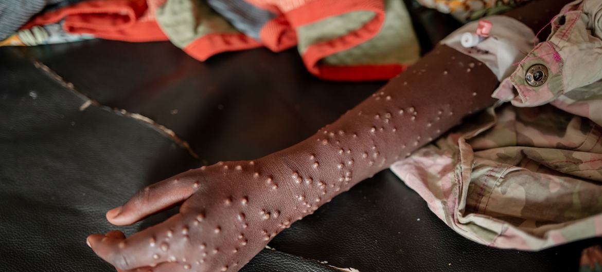 استمرار تفشي جدري القردة في الكونغو الديمقراطية