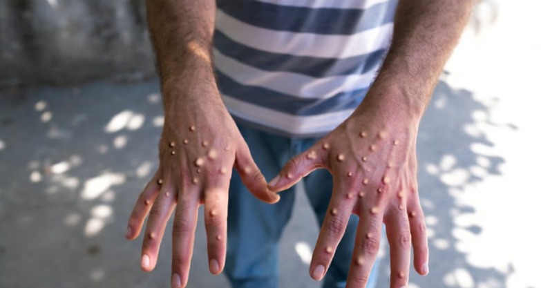 جدري القردة..منظمة الصحة العالمية تمدد حالة الطوارىء