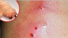 الدودة الحلزونية: طفيلي يلتهم الأنسجة الحية ويختبر يقظة المغرب