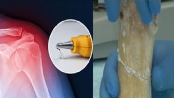 ابتكار صيني مستوحى من بلح البحر قد يغير علاج كسور العظام