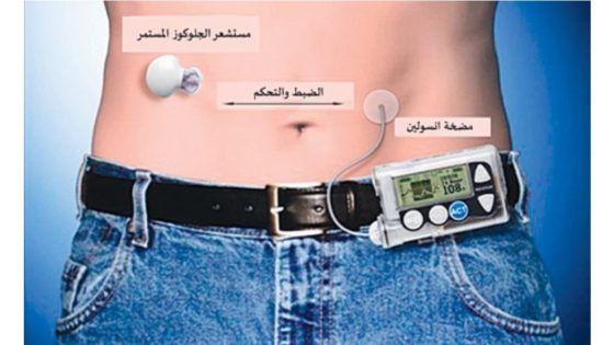 البنكرياس الاصطناعي.. الطب يدخل عصر التحكم الذاتي في علاج السكري